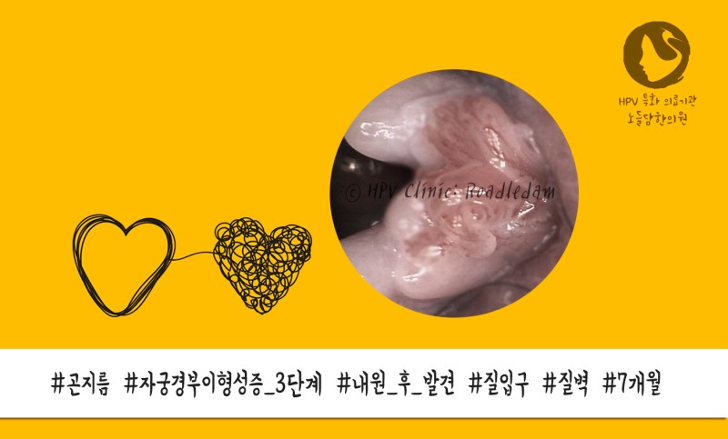 질 사마귀로 불리는 여성 곤지름 왜 치료하기 어렵나 : 네이버 블로그