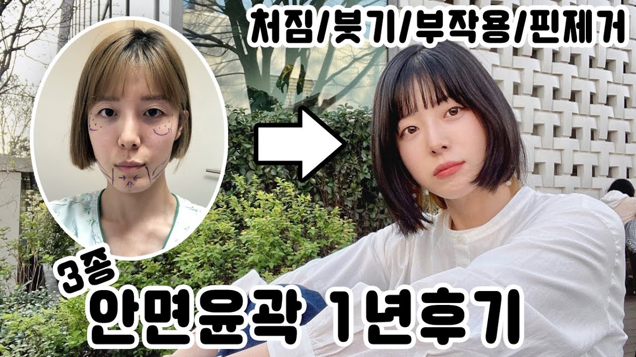 감각 아직 안돌아 왔어요..😭 안면 윤곽 3종 수술 부작용부터 만족도 까지 솔직한 후기 - Youtube