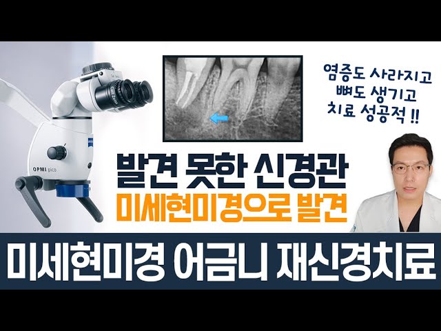 오른쪽 아래 어금니가 가만히 있어도 통증이 있어요ㅜㅜ어금니염증재발?왜? 발견하지 못한 신경관 미세현미경으로 찾아 재신경치료! 진짜 뼈가  차오를까?(치료 성공적! 경과 매우 좋음🧐) - Youtube