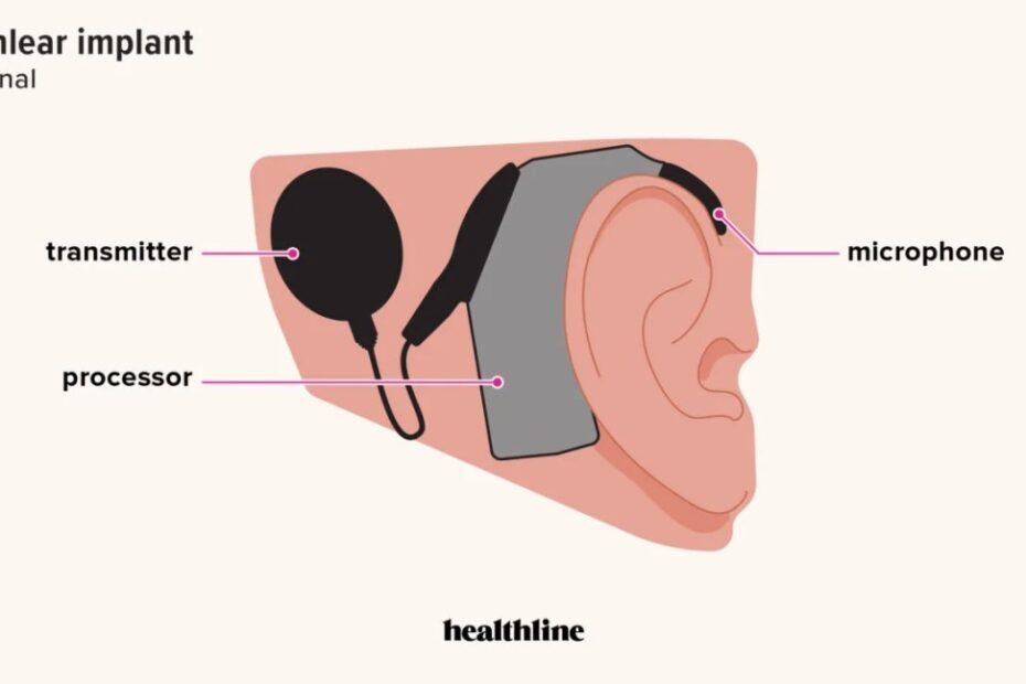 Cochlear Implant: Cost, Pros, Cons, Risks, How It Works