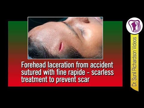 Forehead laceration from accident sutured with fine rapide - scarless treatment to prevent scar Forehead laceration from accident sutured with fine rapide - scarless treatment to prevent scar